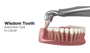 Wisdom Tooth Extraction